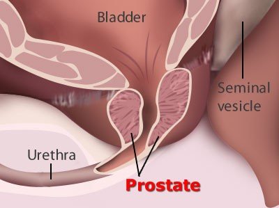 pictures-of-prostate-cancer