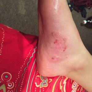 blisters with liquid on feet
