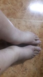 swollen-feet-and-legs
