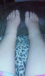 swollen-feet