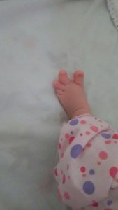 baby-deformed-toes