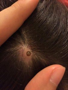scalp-tumor