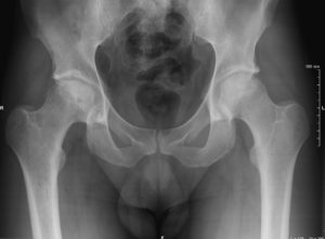 arthrosis-of-the-hip