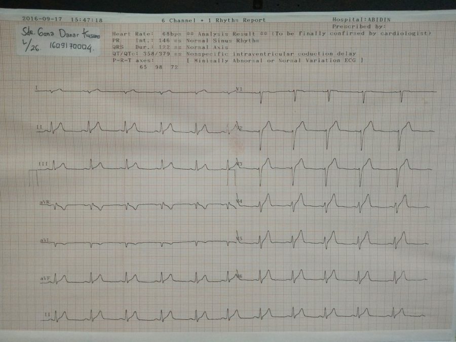 my-ecg-is-abnormal-what-is-wrong-with-me-ask-a-doctor-free-share