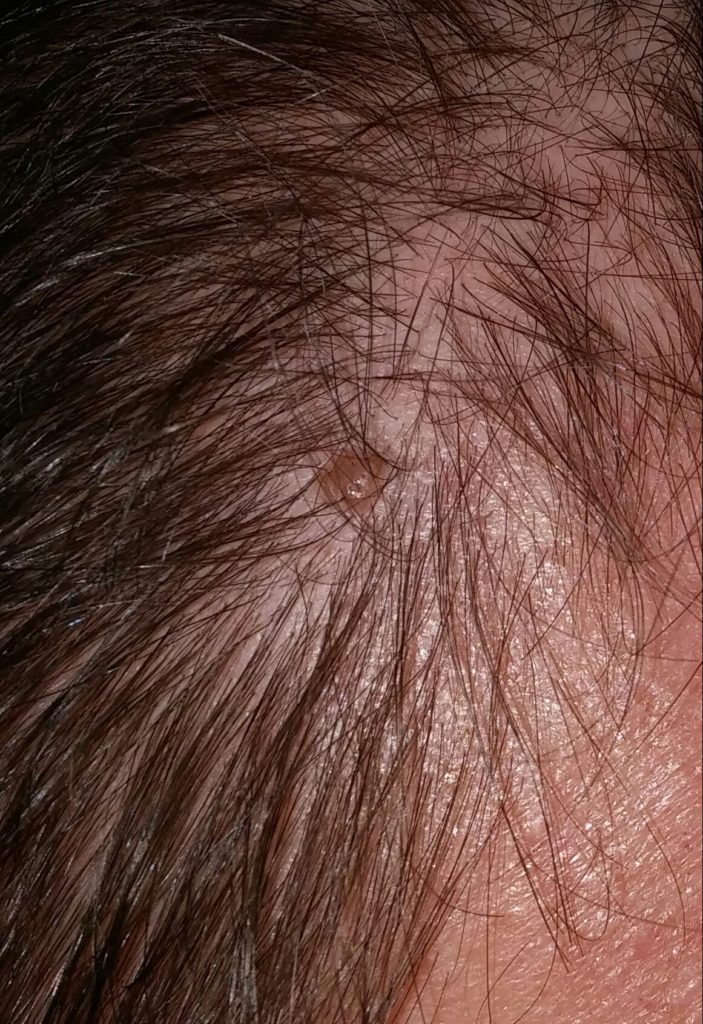 I have growth on my scalp, getting bigger? - Ask a doctor free. Share ...