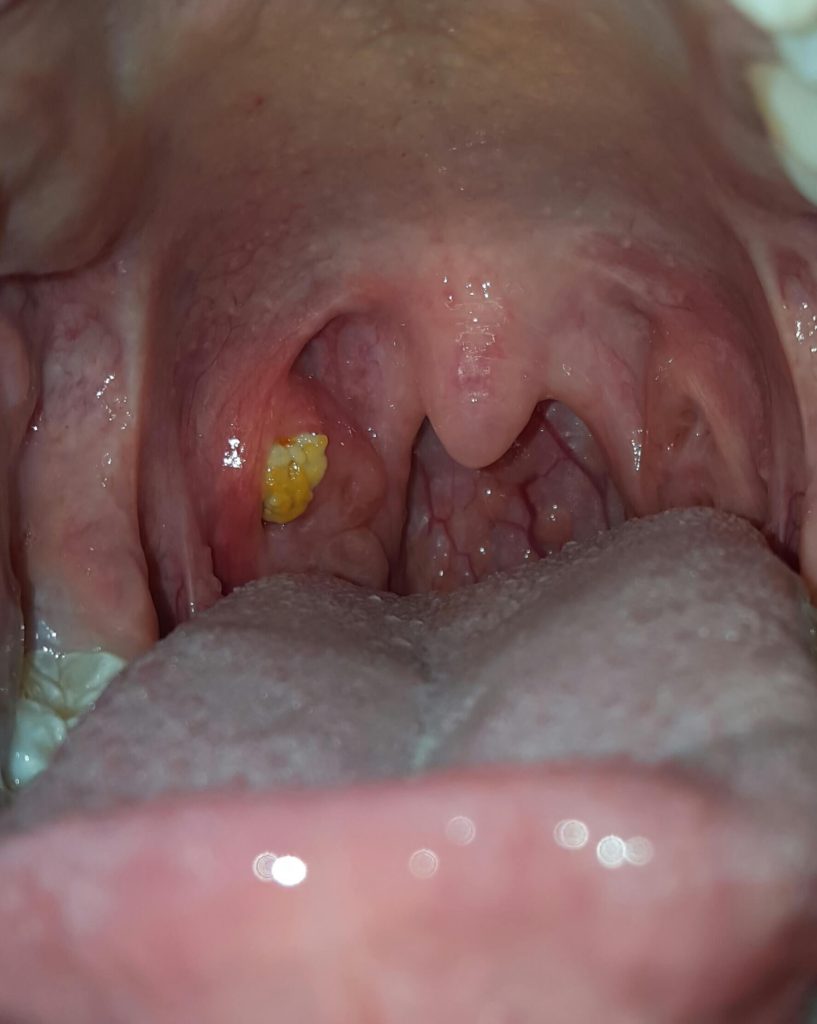 Canker Sores