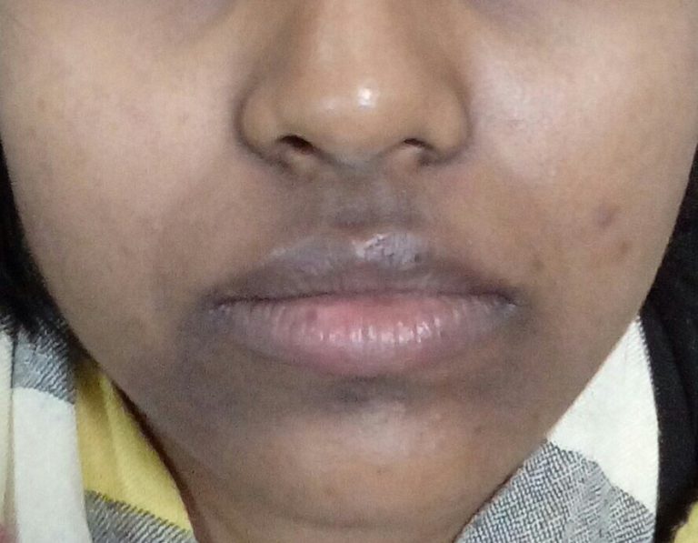 i-have-hyperpigmentation-around-my-mouth-for-ten-years-is-this-curable