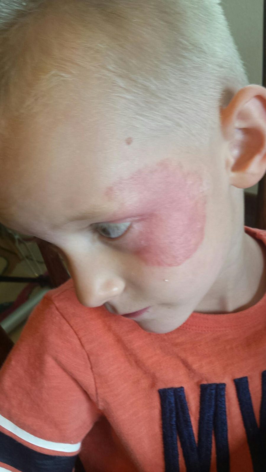 My 6 year old son started getting this rash around his left eye, it is growing rapidly? Ask a
