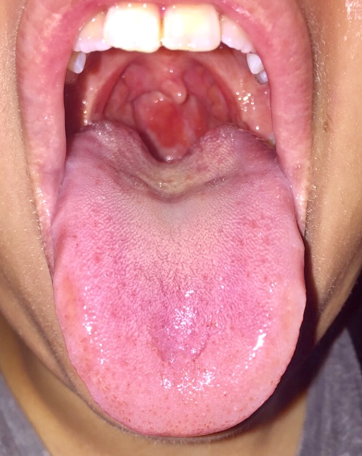 Acid reflux effect on throat