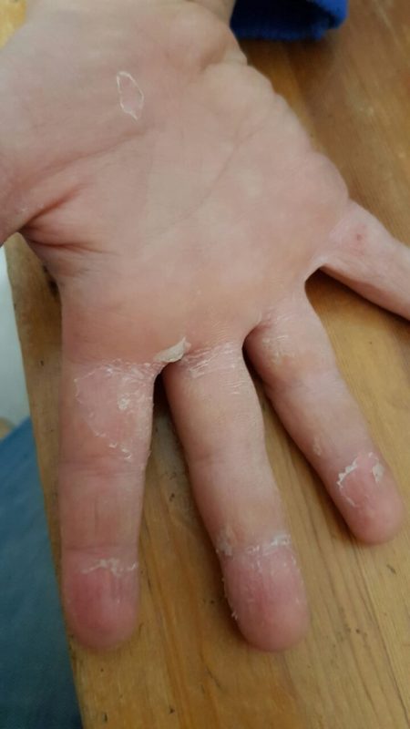 my-son-is-6-years-old-his-skin-is-peeling-is-it-dangerous-ask-a