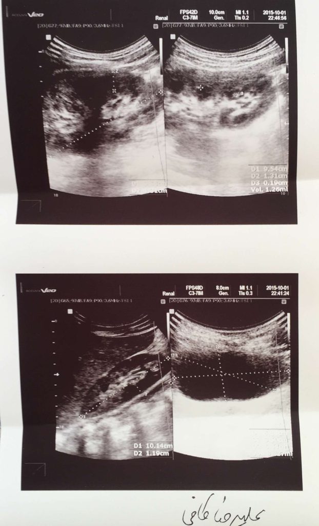 I was born with bladder Extrophy, how to reduce kidney pain and get