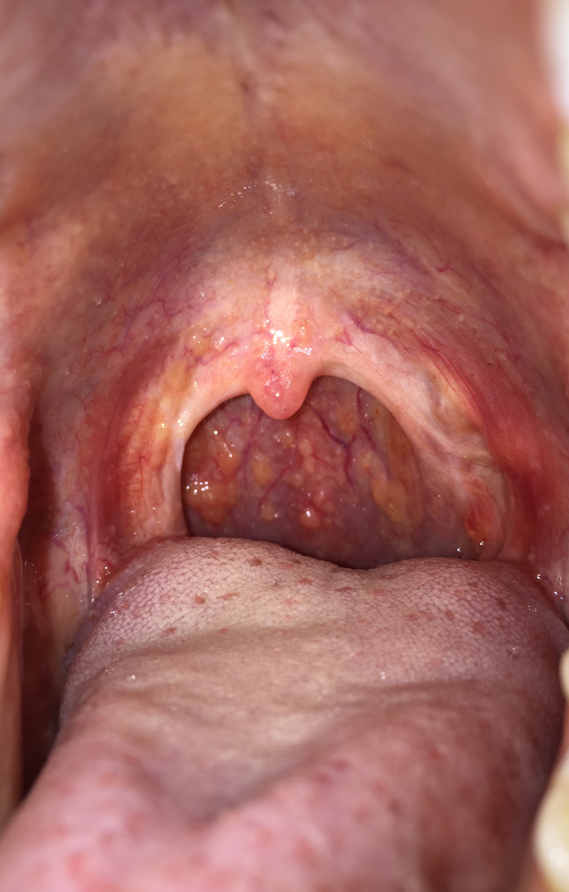 Red Bumps In My Throat 19