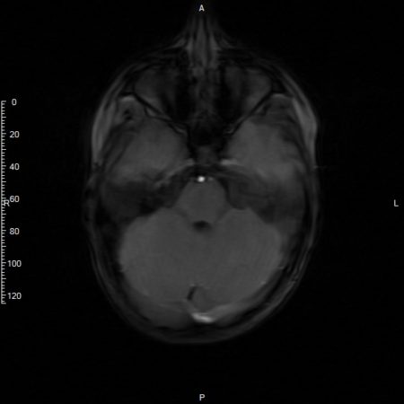 I have undifferentiated connective tissue disease. Brain MRI shows