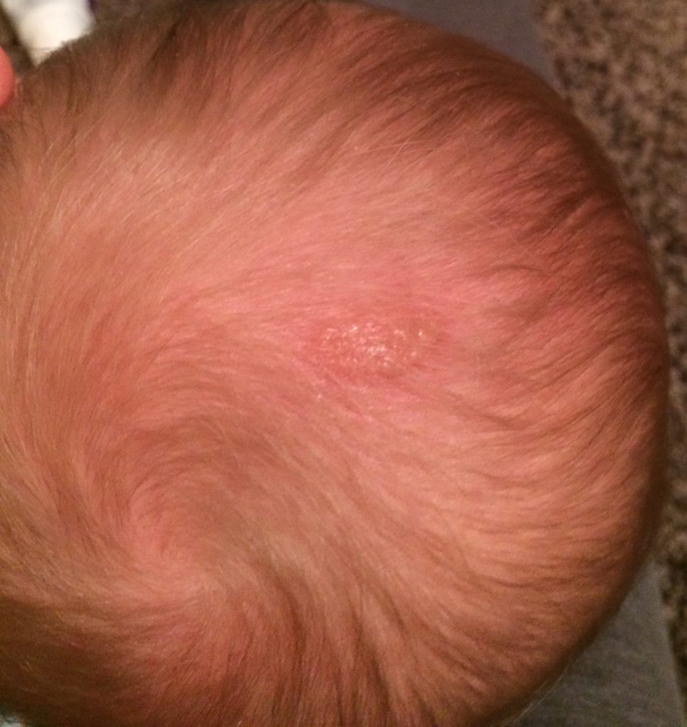 my-8-month-old-daughter-just-developed-this-sore-rash-on-her-scalp