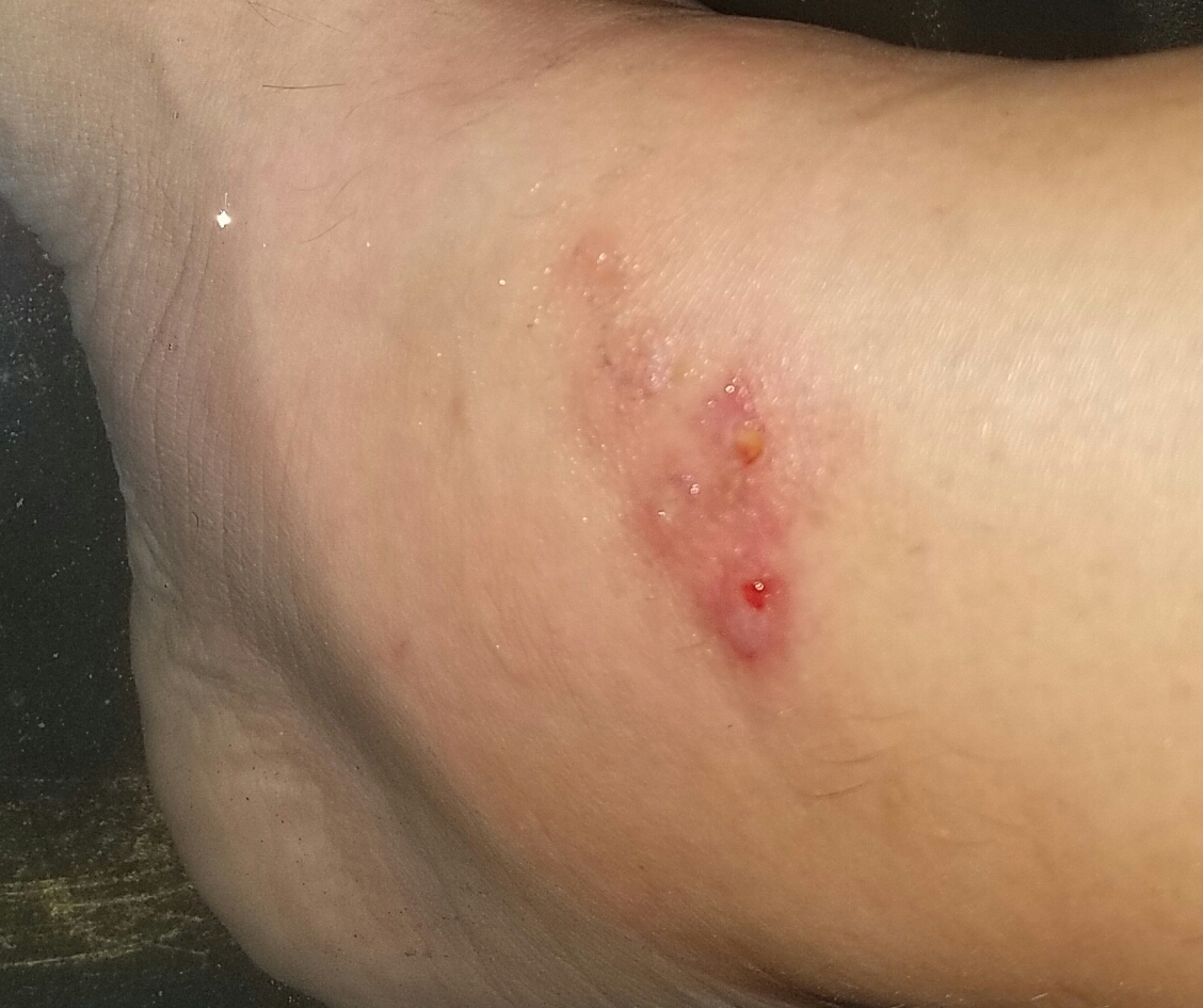 quick red with white surrounding itrash in fold of thigh