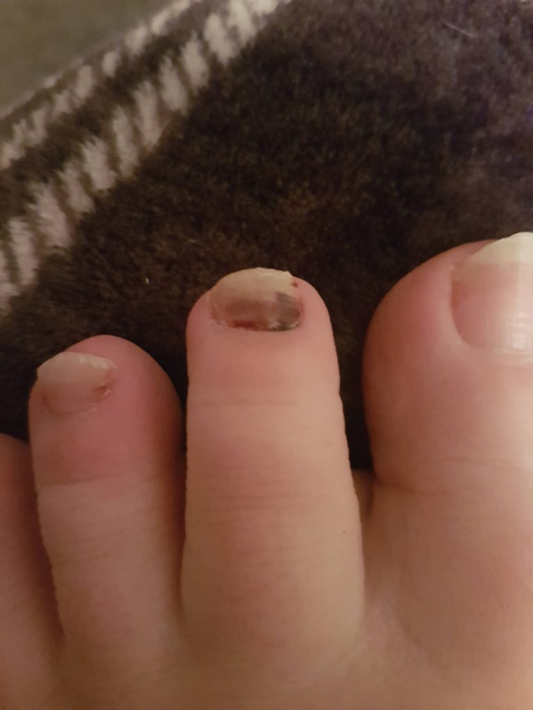 I have a black toenail, what could cause it and what could be done ...