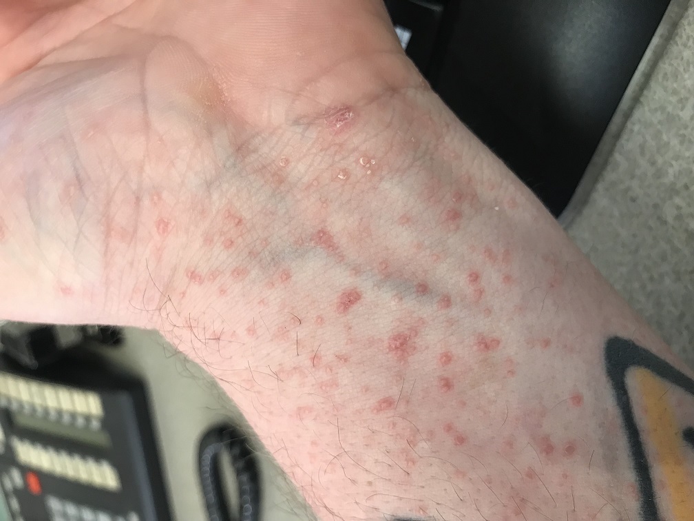 A rash has developed on hands, chest, belly and feet