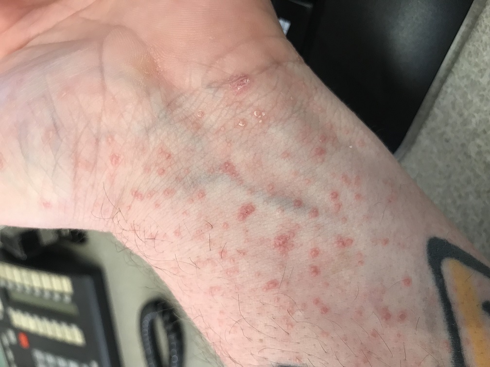 Painful Red Rash On Hands And Feet