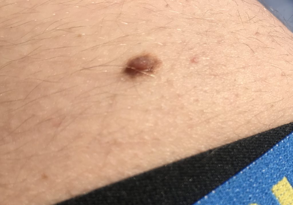 I found a lump at the bottom of my back that is small, pink and brown