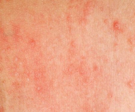 I have this itchy patch of skin on my leg, what is it? - Ask a doctor ...