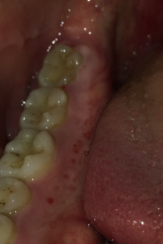 i-have-red-spots-on-only-my-right-lower-gum-line-ask-a-doctor-free